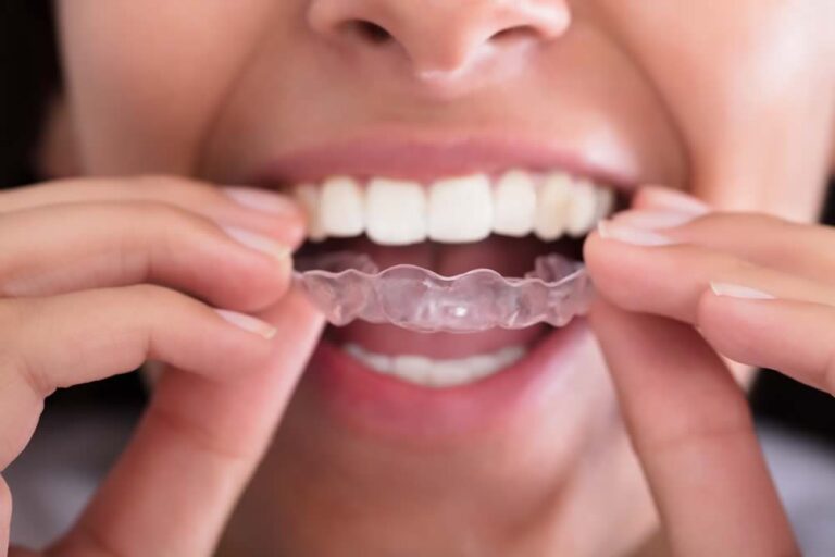 The Advantages of Invisalign: A Sydney Perspective